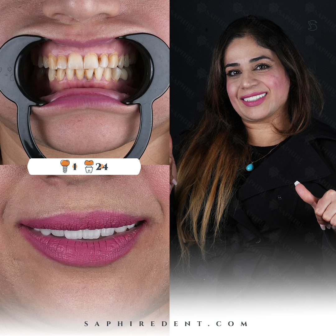 Hollywood Smile